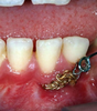 BIOMÉCANIQUE : Maîtriser les clés de l'excellence en orthodontie