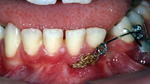 BIOMÉCANIQUE : Maîtriser les clés de l'excellence en orthodontie