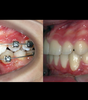 BIOMÉCANIQUE : Maîtriser les clés de l'excellence en orthodontie