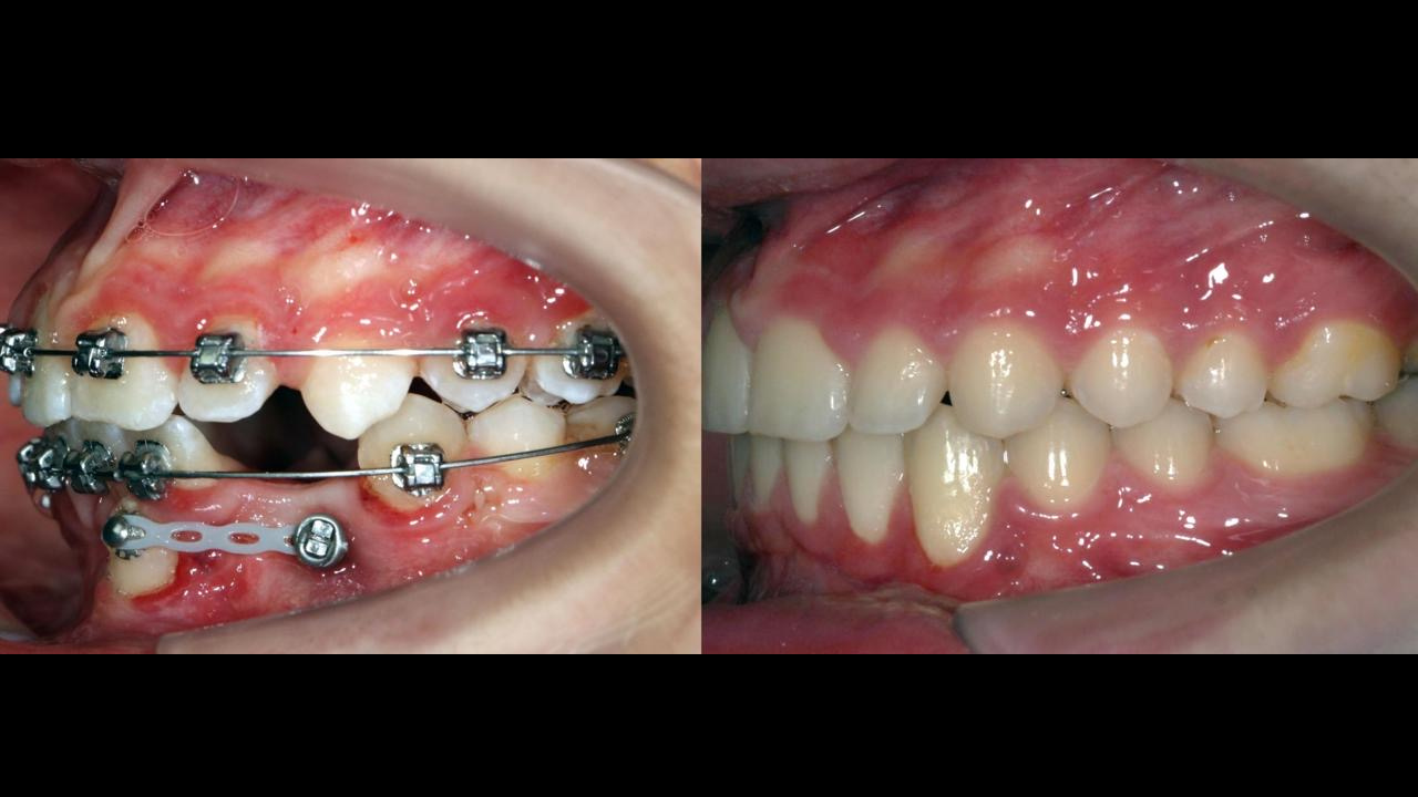 BIOMÉCANIQUE : Maîtriser les clés de l'excellence en orthodontie