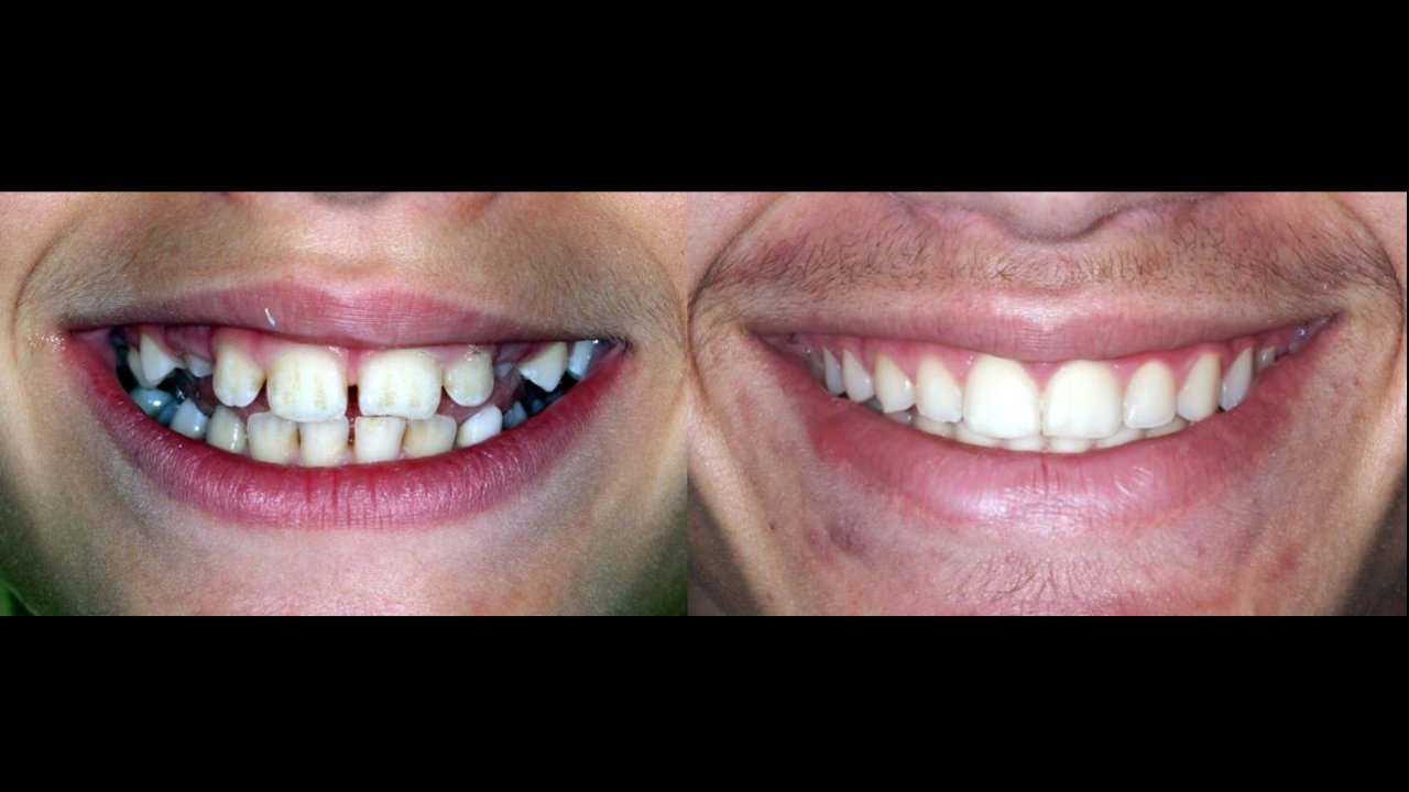 BIOMÉCANIQUE : Maîtriser les clés de l'excellence en orthodontie