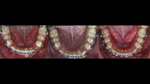 BIOMÉCANIQUE : Maîtriser les clés de l'excellence en orthodontie