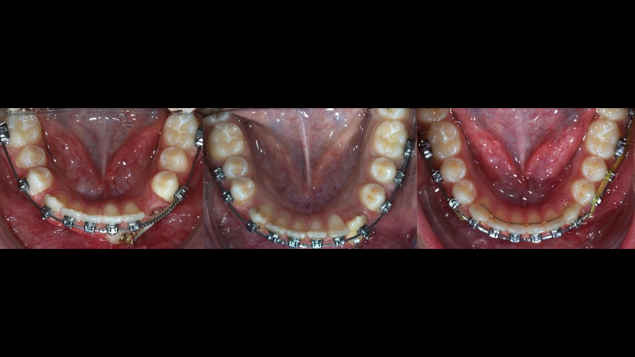 BIOMÉCANIQUE : Maîtriser les clés de l'excellence en orthodontie