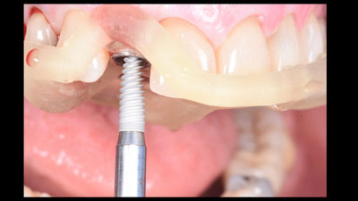 Replay: La chirurgie guidée implantaire en omnipratique : trucs & astuces.