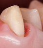 Retraitement biomimétique des dents couronnées