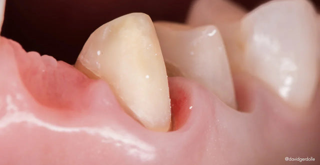 Retraitement biomimétique des dents couronnées