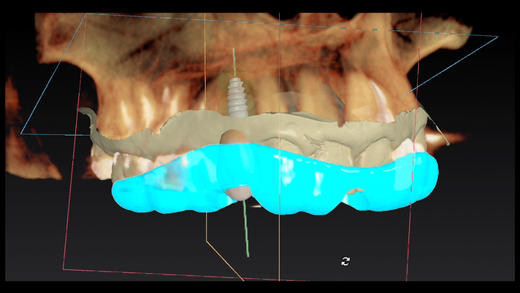 GUIDED CLINICAL IMPLANTOLOGY