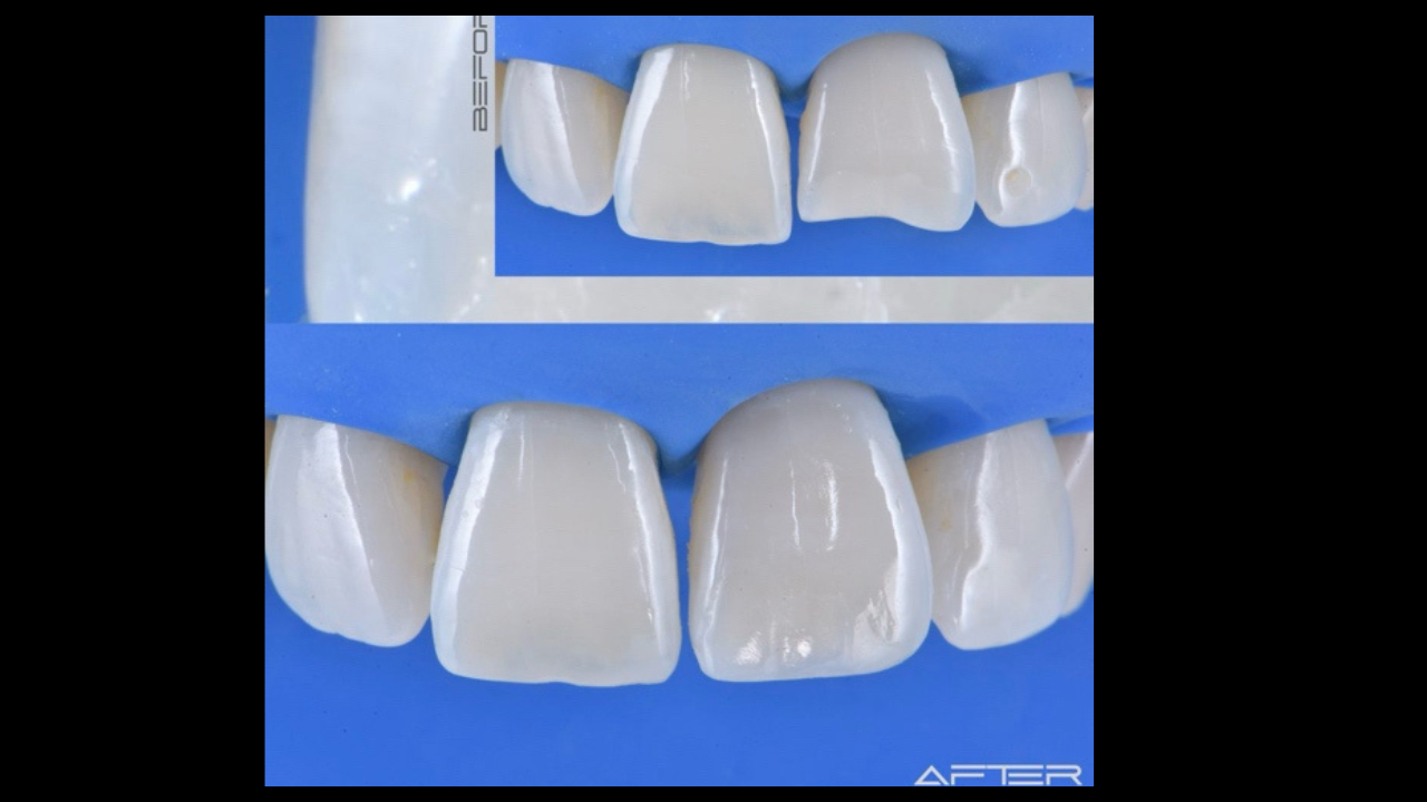 Restauration Antérieure : Immersion totale avec TP