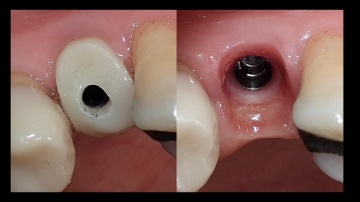 GUIDED CLINICAL IMPLANTOLOGY