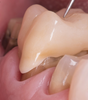 Retraitement biomimétique des dents couronnées