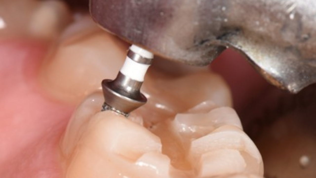 Afterwork : Comprendre la zircone pour éviter les échecs