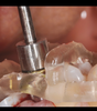 IMPLANTOLOGIE CLINIQUE GUIDEE