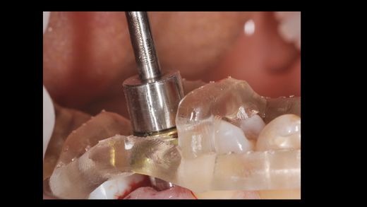 GUIDED CLINICAL IMPLANTOLOGY