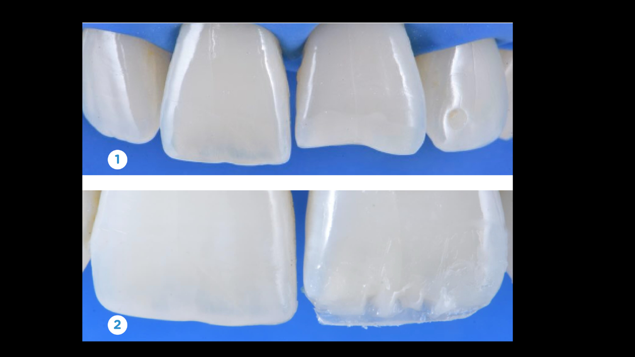 Restauration Antérieure : Immersion totale avec TP