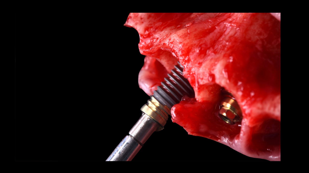 Le challenge esthétique et stratégie implantaire : une approche multidisciplinaire