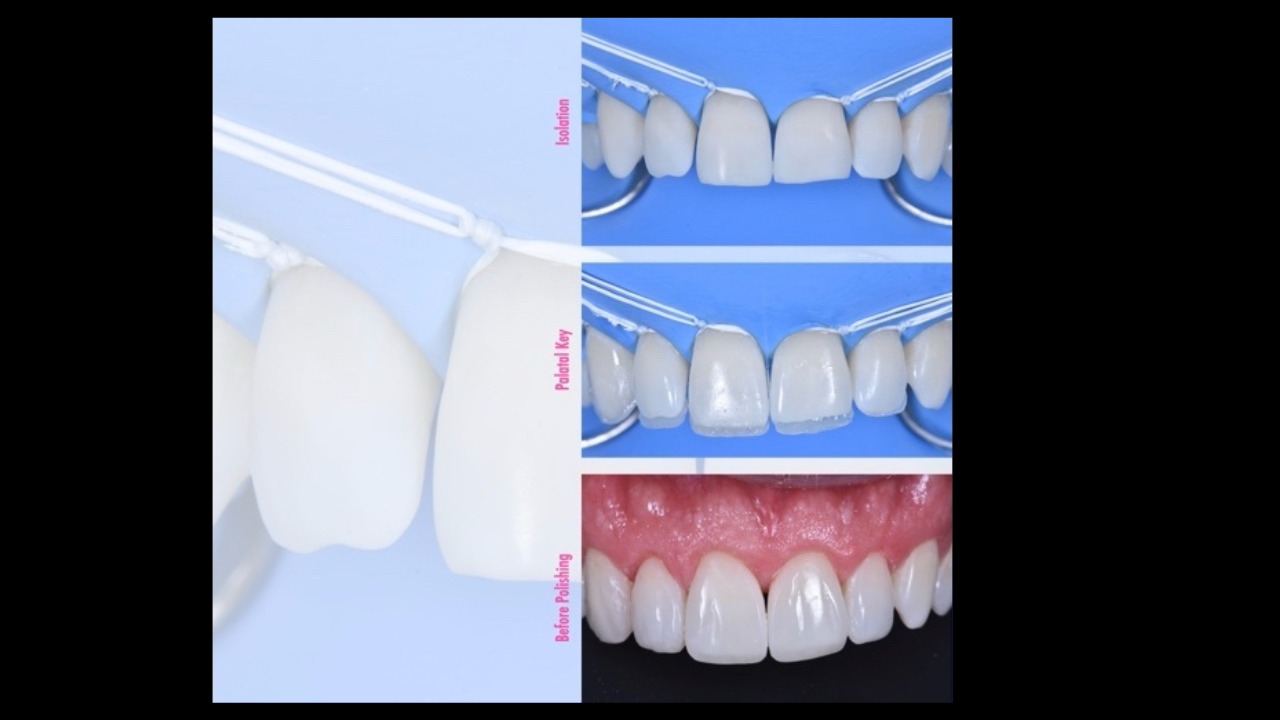 Restauration Antérieure : Immersion totale avec TP