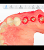 IMPLANTOLOGIE CLINIQUE GUIDEE