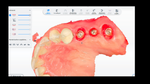 IMPLANTOLOGIE CLINIQUE GUIDEE