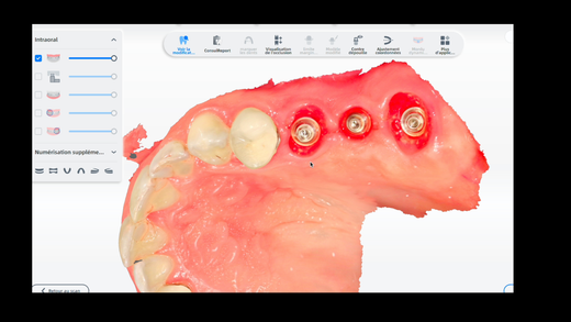 GUIDED CLINICAL IMPLANTOLOGY