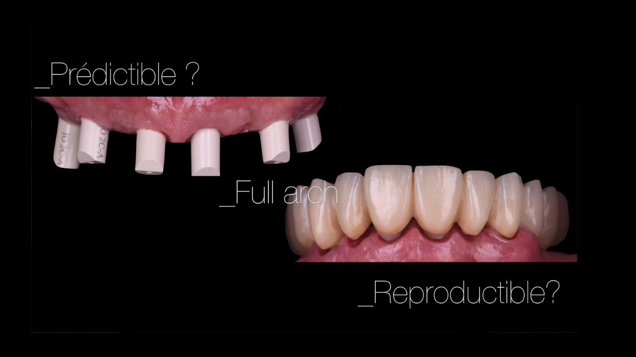 Le challenge esthétique et stratégie implantaire : une approche multidisciplinaire