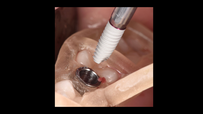Replay: La chirurgie guidée implantaire en omnipratique : trucs & astuces.