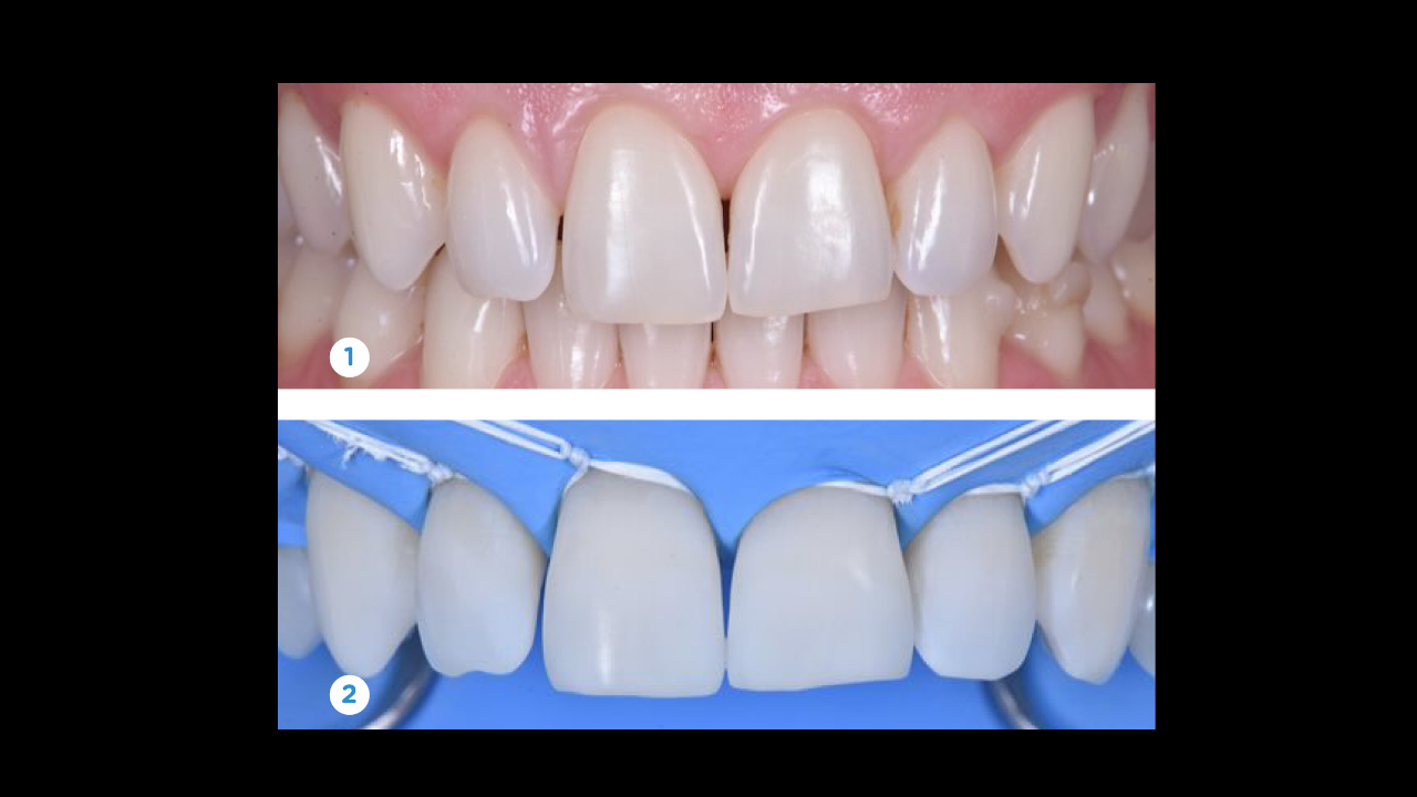 Restauration Antérieure : Immersion totale avec TP