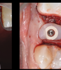 IMPLANTOLOGIE CLINIQUE GUIDEE