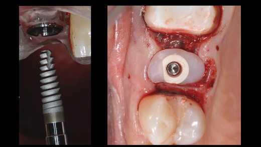 GUIDED CLINICAL IMPLANTOLOGY