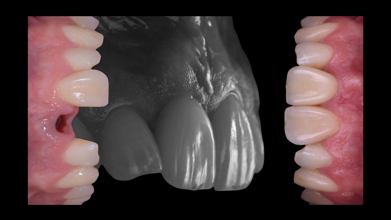 Le challenge esthétique et stratégie implantaire : une approche multidisciplinaire
