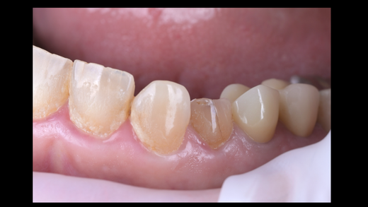 GUIDED CLINICAL IMPLANTOLOGY