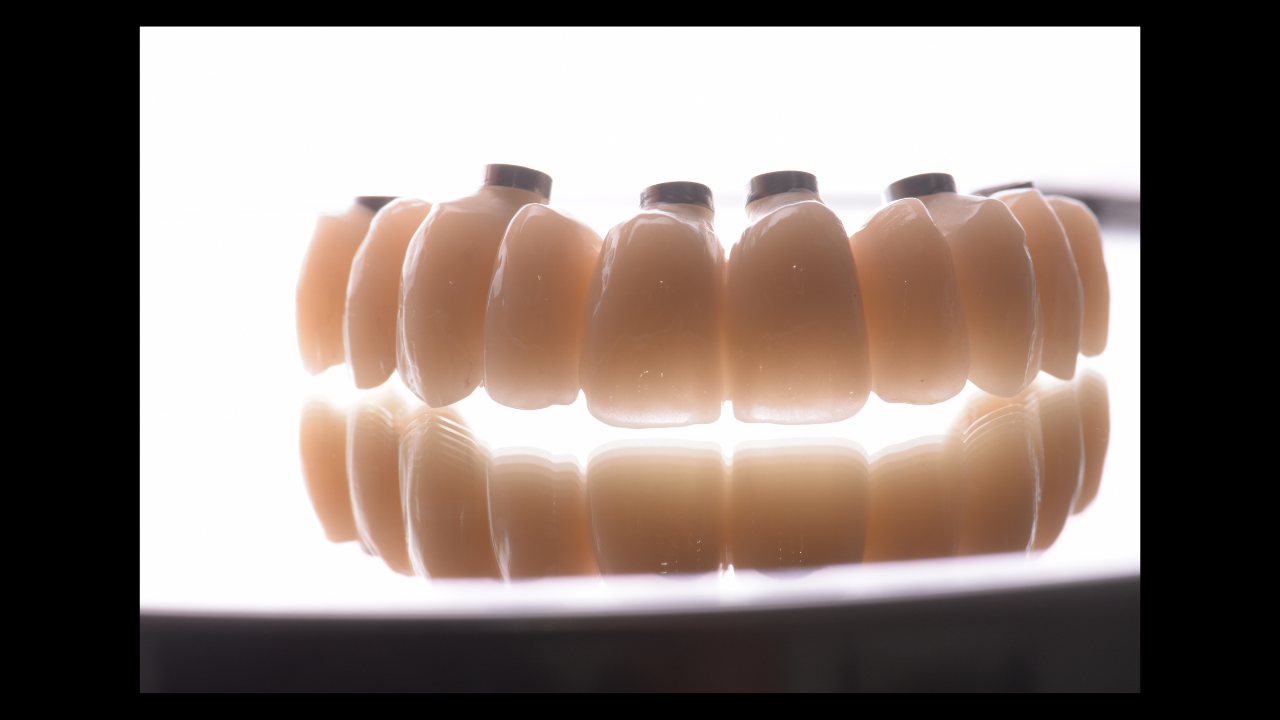 Le challenge esthétique et stratégie implantaire : une approche multidisciplinaire