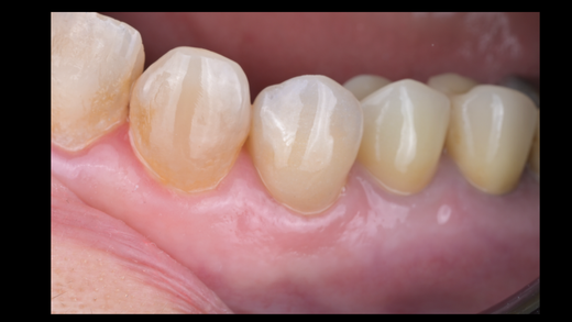 GUIDED CLINICAL IMPLANTOLOGY