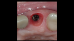 IMPLANTOLOGIE CLINIQUE GUIDEE