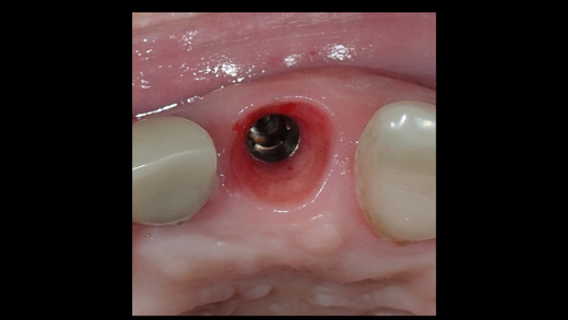 GUIDED CLINICAL IMPLANTOLOGY