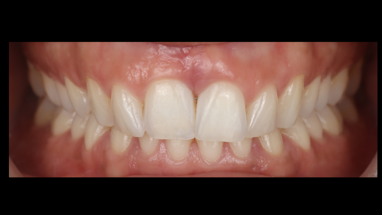 Restauration esthétique post-parodontale : stratégies directes minimalement invasives