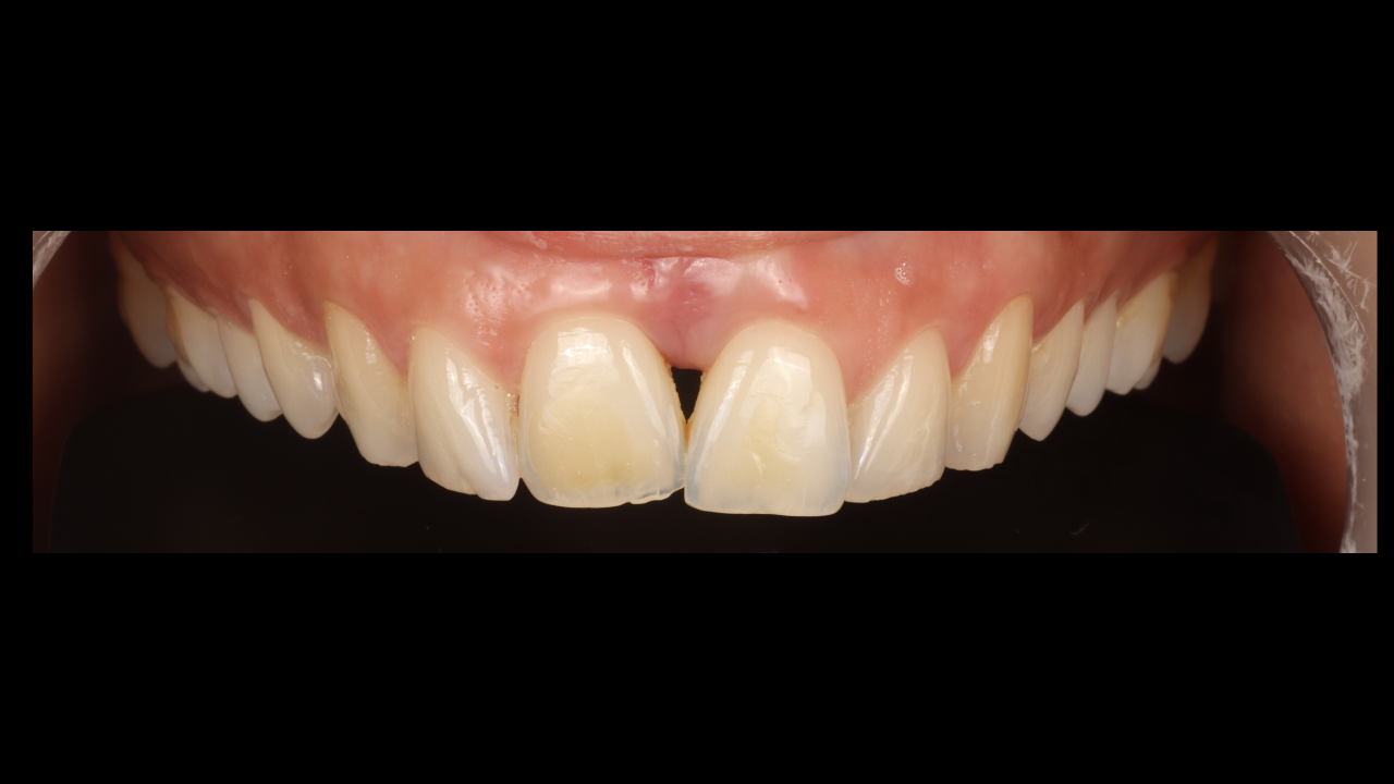 Restauration esthétique post-parodontale : stratégies directes minimalement invasives