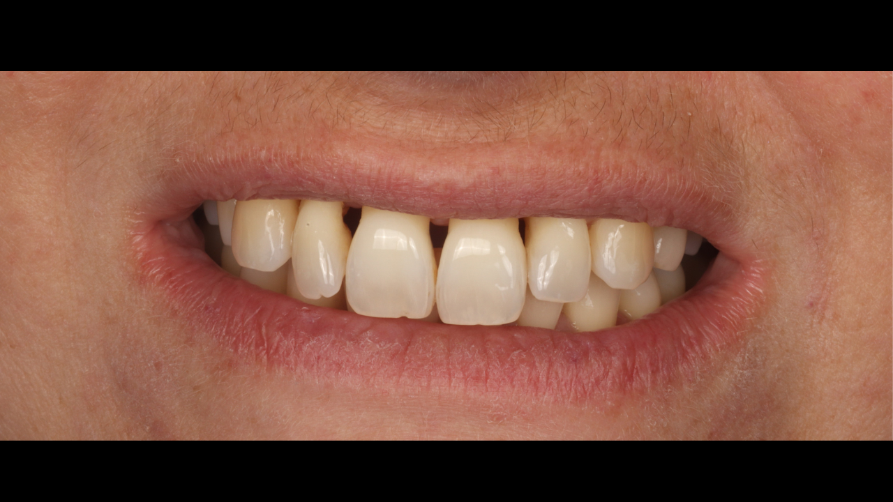 Restauration esthétique post-parodontale : stratégies directes minimalement invasives