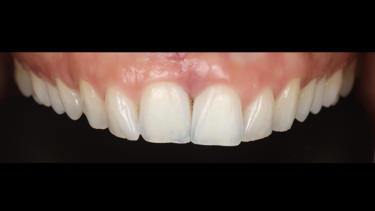 Restauration esthétique post-parodontale : stratégies directes minimalement invasives