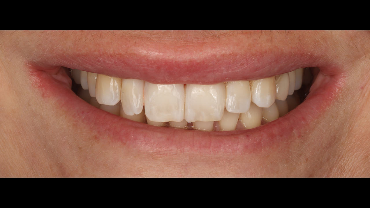 Restauration esthétique post-parodontale : stratégies directes minimalement invasives