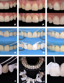 L’injection de composite fluide