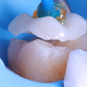 La chirurgie guidée implantaire en omnipratique : trucs & astuces.