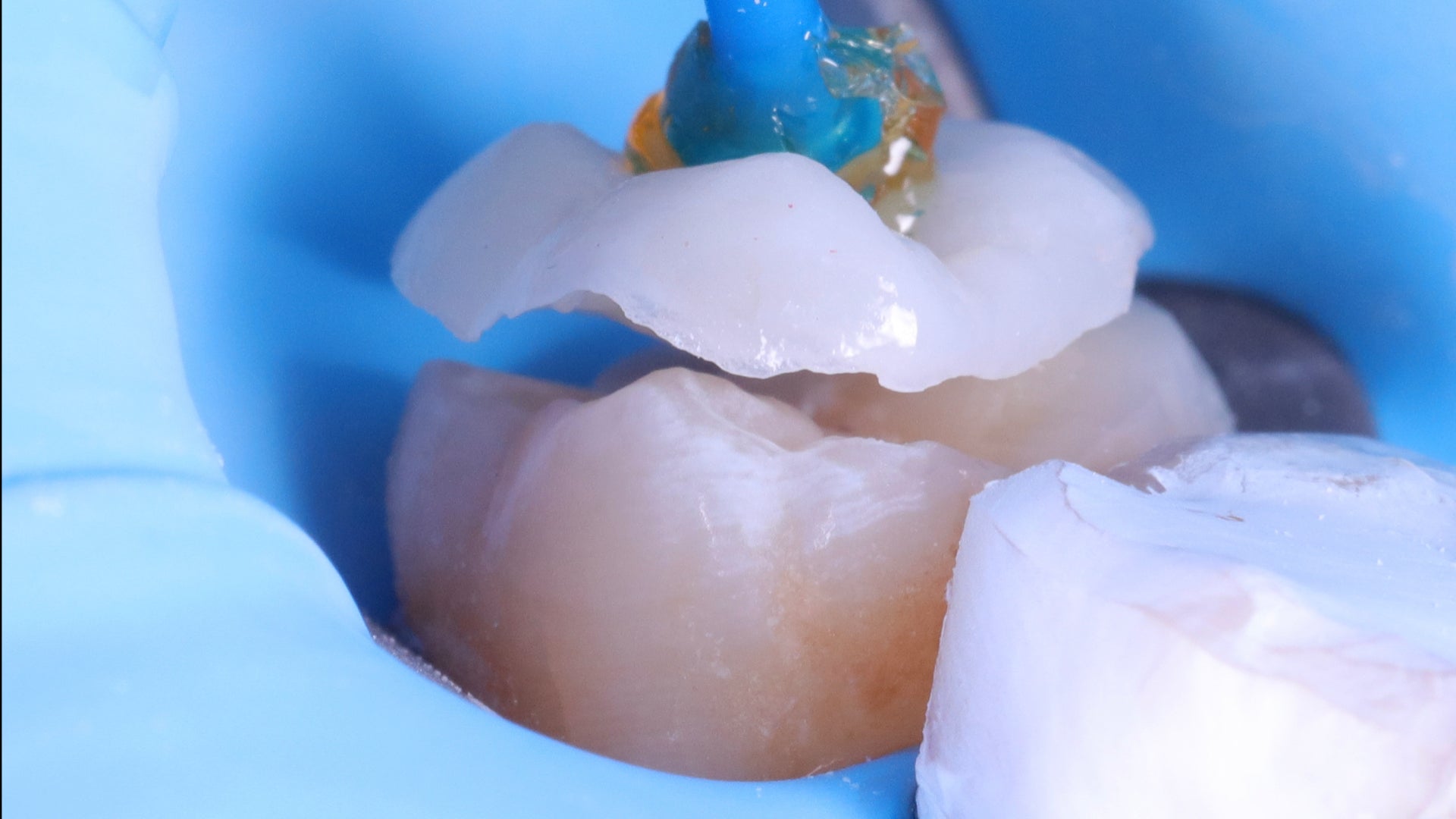 La chirurgie guidée implantaire en omnipratique : trucs & astuces.
