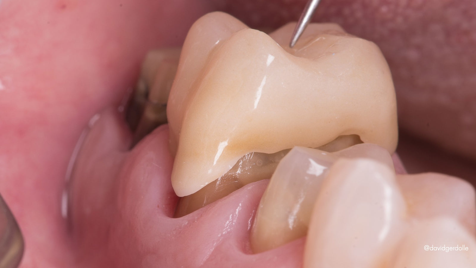 Retraitement biomimétique des dents couronnées