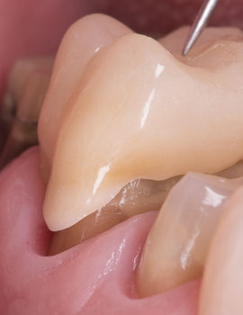 Retraitement biomimétique des dents couronnées