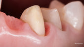 Retraitement biomimétique des dents couronnées