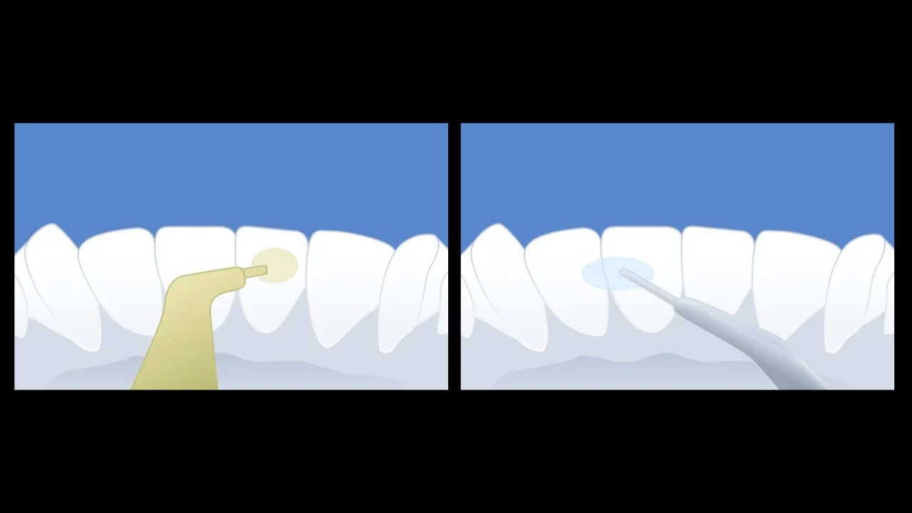 Adieu les urgences : maîtriser le collage des contentions