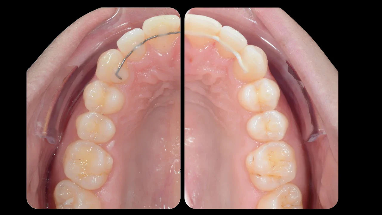 Comparaison avant-après orthodontie Capsule, vue palais dentaire avec et sans fil de contention