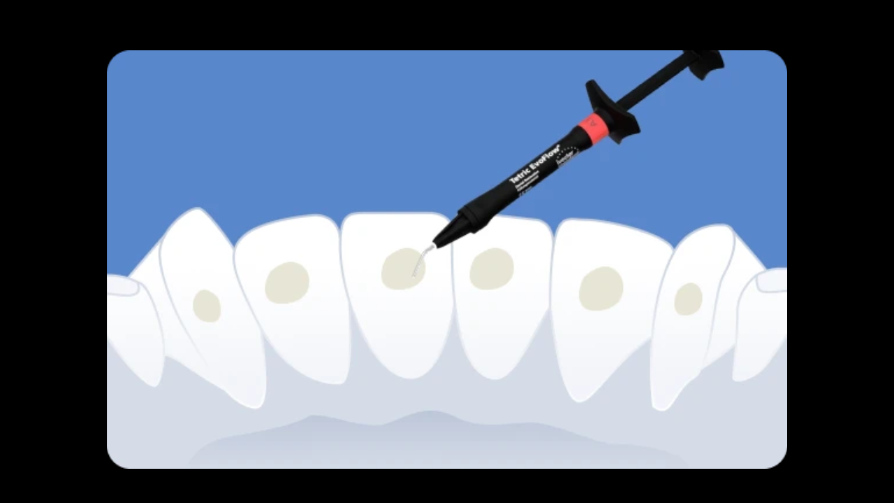 Adieu les urgences : maîtriser le collage des contentions