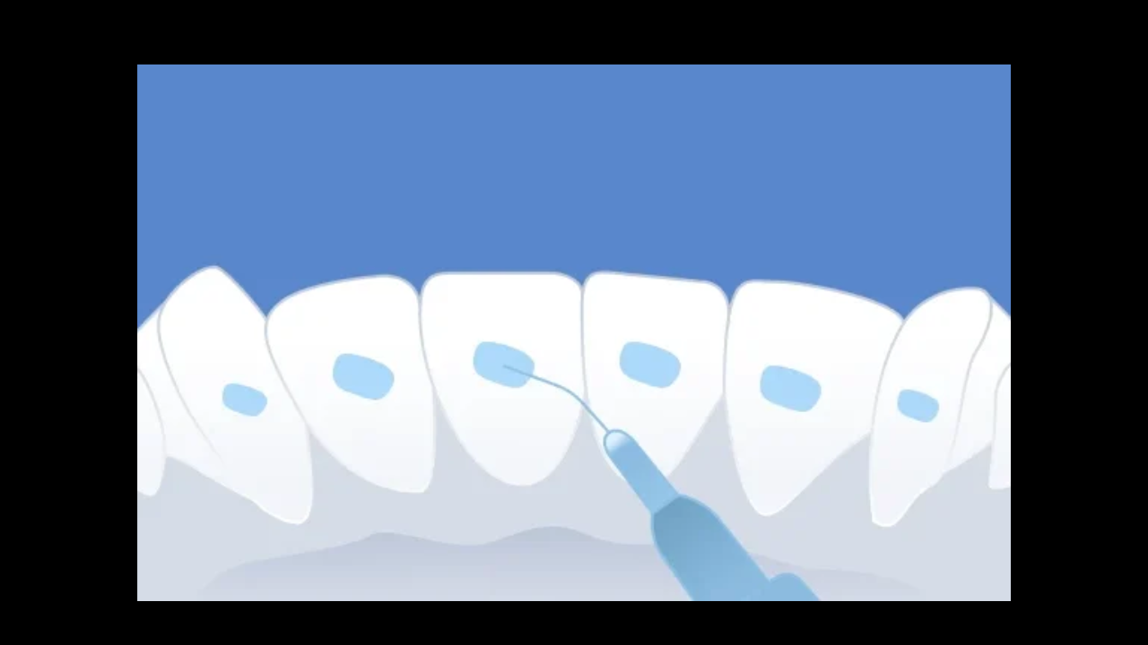 Adieu les urgences : maîtriser le collage des contentions