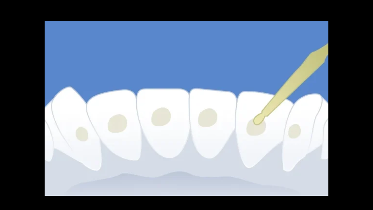 Adieu les urgences : maîtriser le collage des contentions